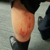 City Councilman Marcus Lundy's leg after today's altercation.